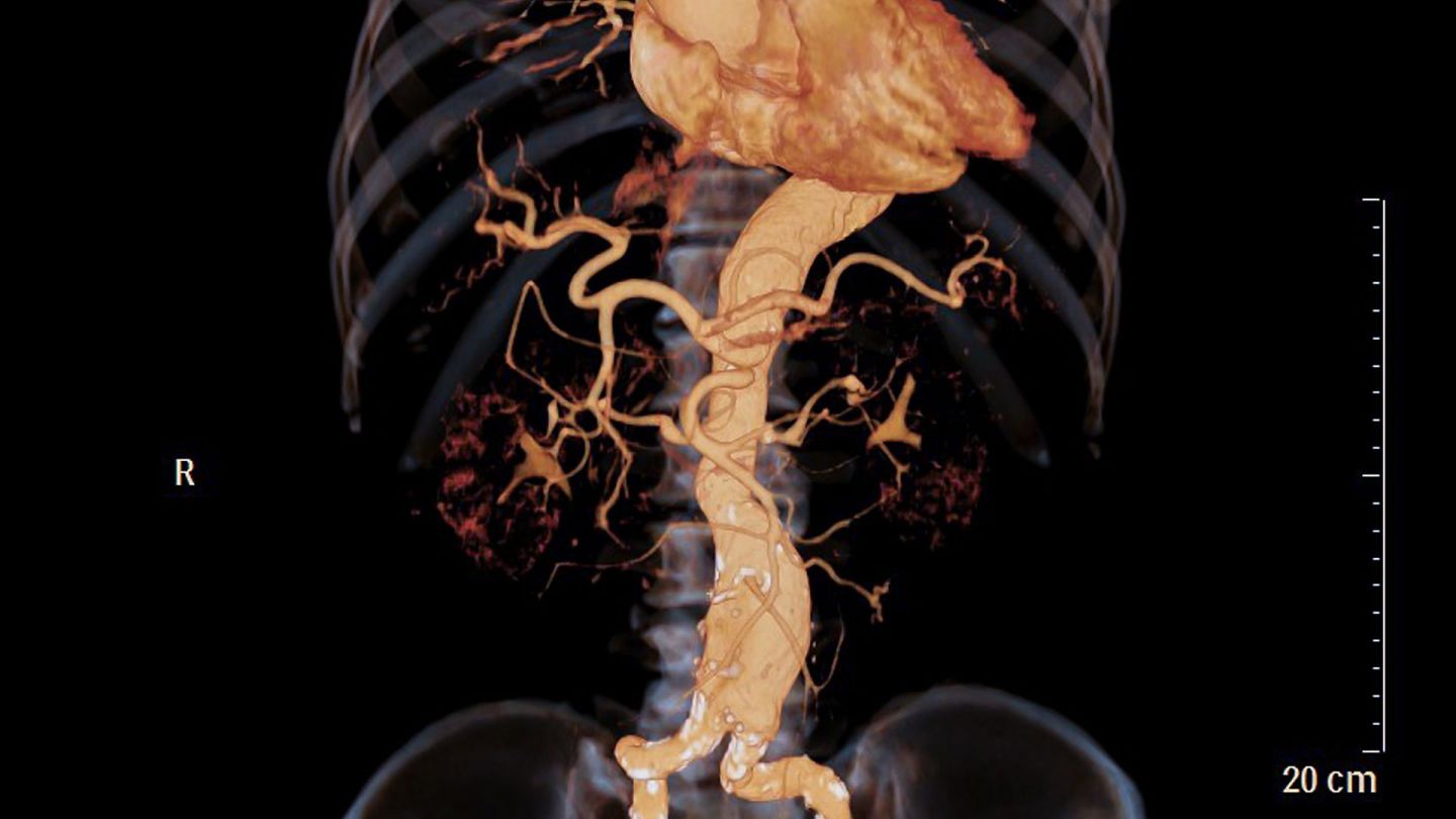 Abdominal aortic aneurysm: color image of a human abdominal artery (aorta).