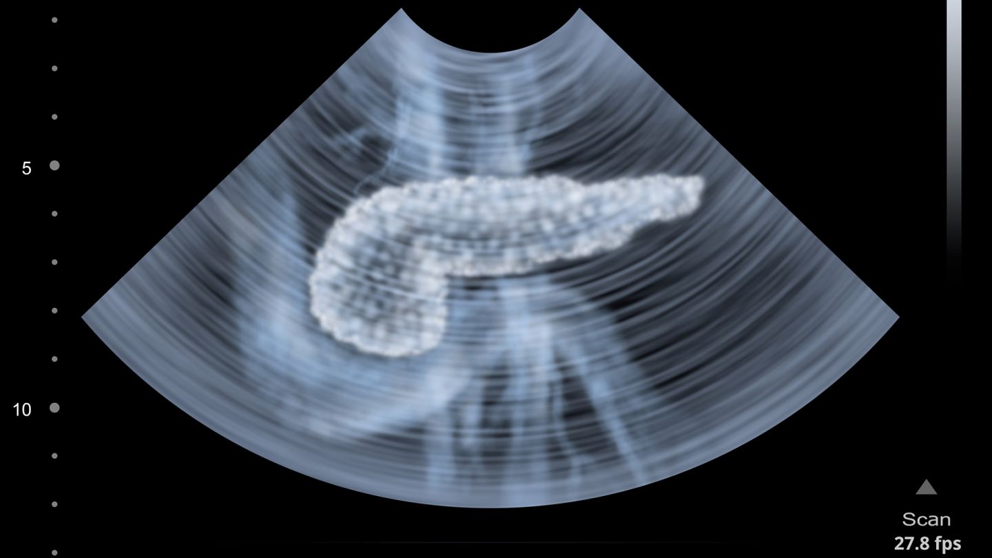 Pankreas kanseri: İnsan pankreasını gösteren bir ultrason görüntüsü.