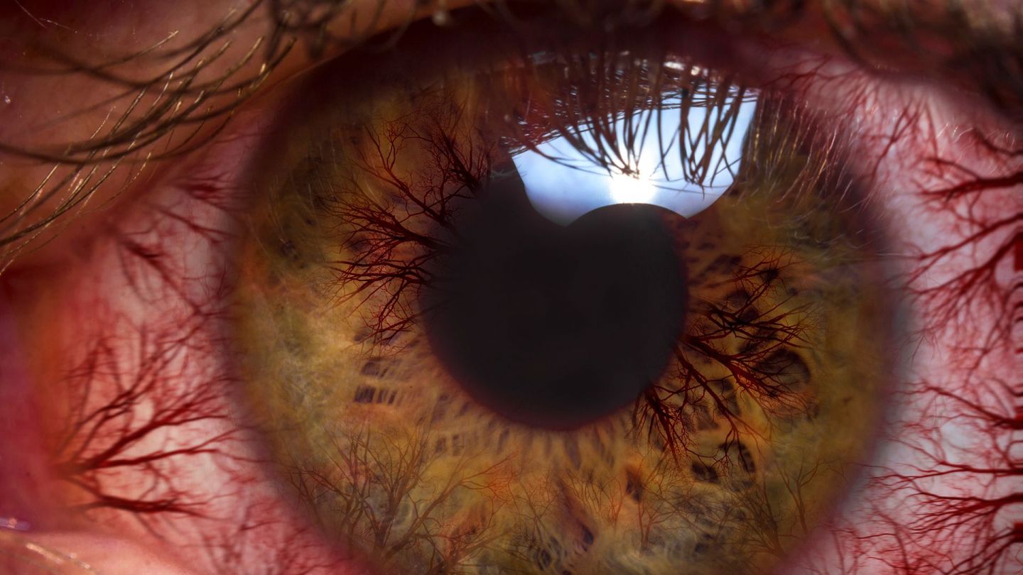 Воспаление конъюнктивы (конъюнктивит). Снимок человеческого глаза крупным планом. На белке глаза хорошо различимы многочисленные мелкие красные кровеносные сосуды. На верхнем крае зрачка — блик света.