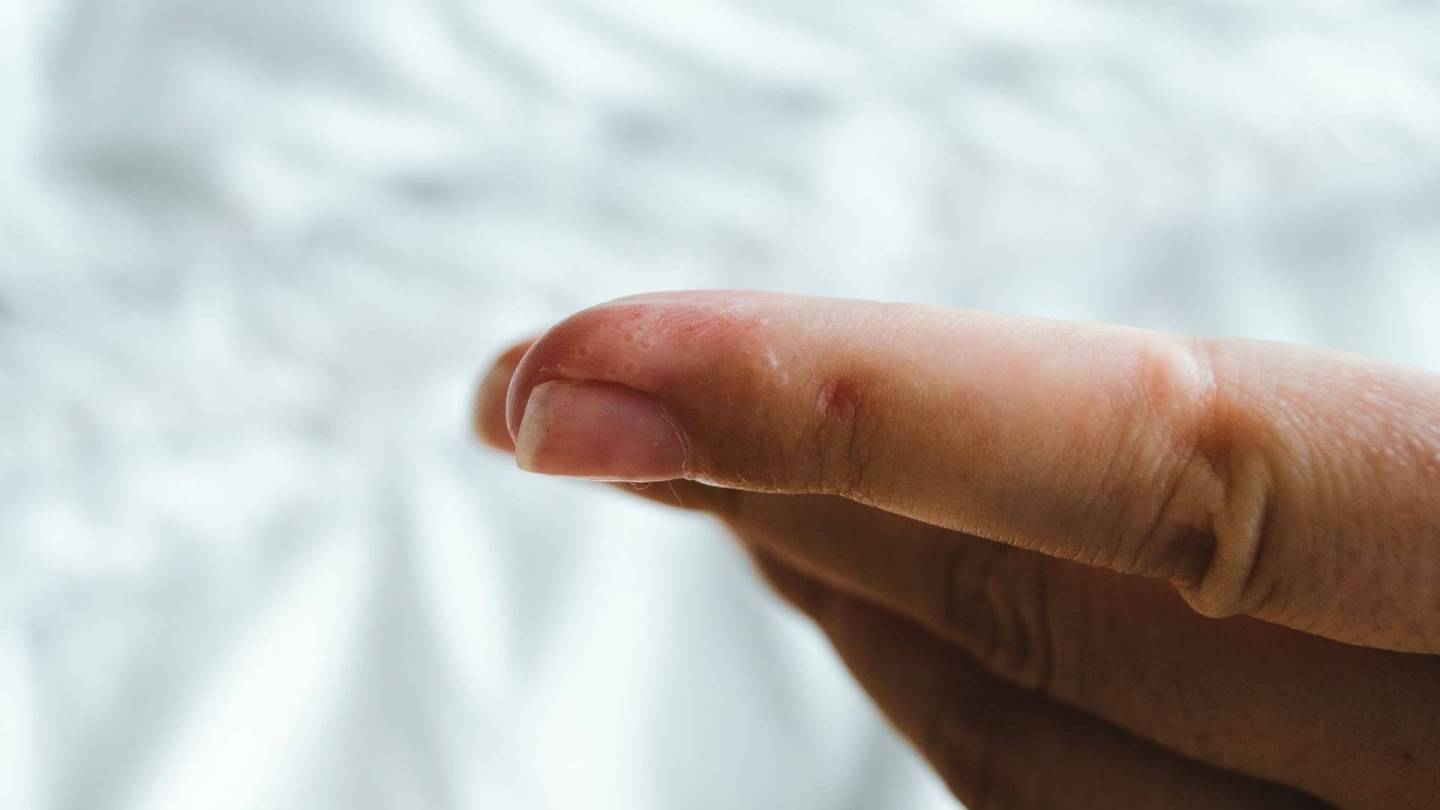 Forefinger with several contiguous blisters.
