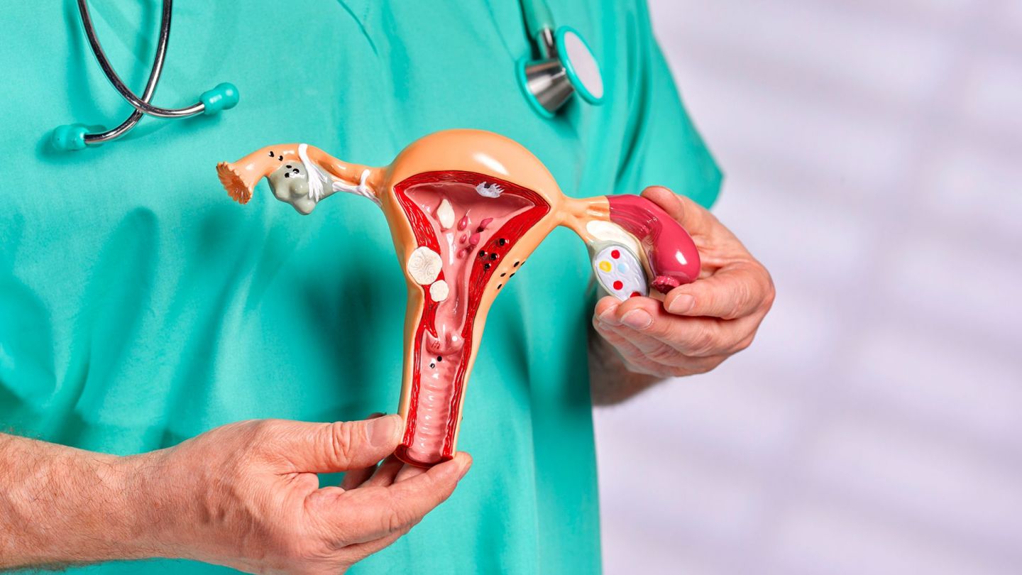Womb cancer (uterine or endometrial cancer): doctor holding a model of a uterus in both hands.