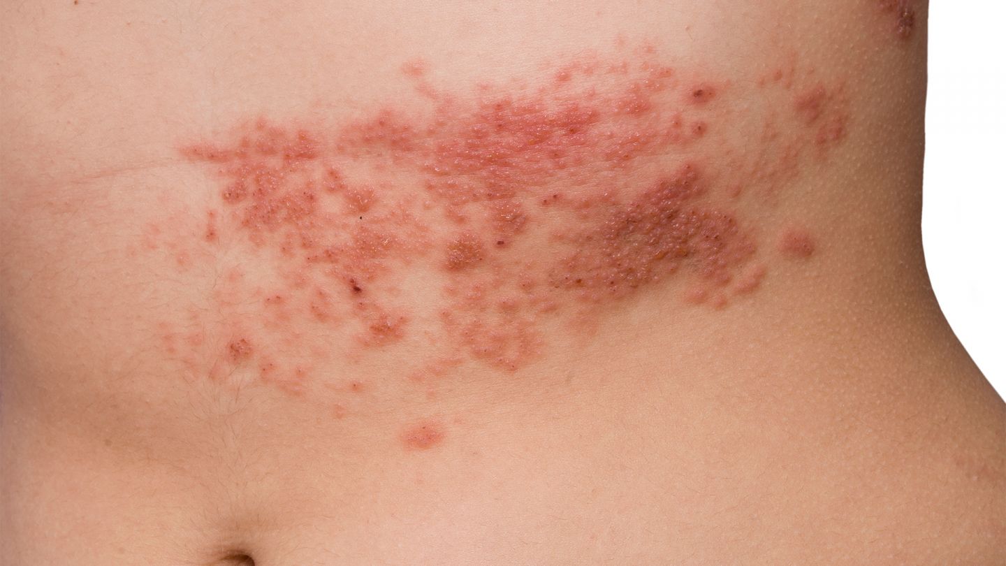 Woman’s naked upper abdomen with the rash characteristic of shingles (herpes zoster).
