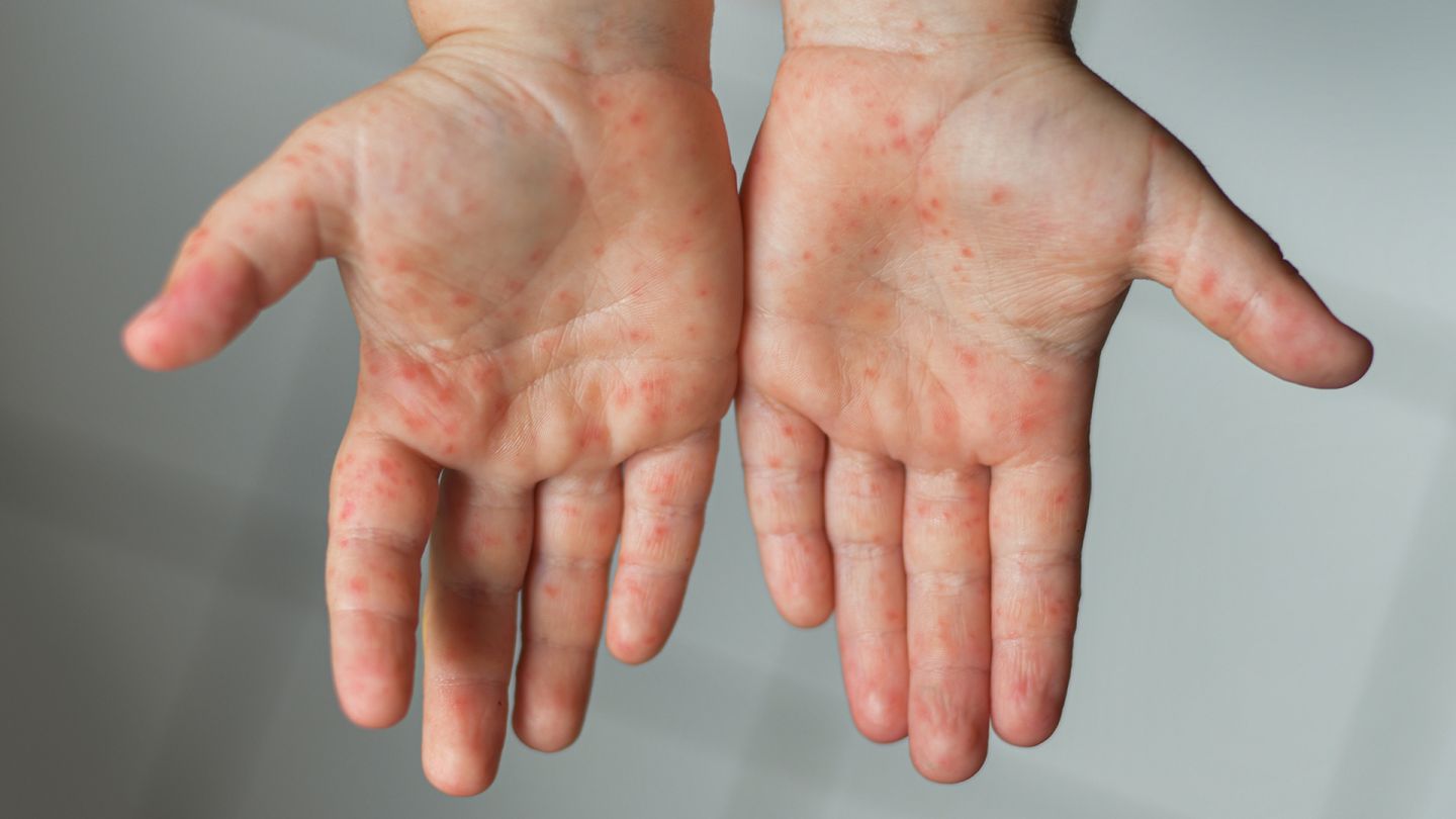 Hand-Fuß-Mund-Krankheit: Bläschenartige Wunden auf den Händen eines Kindes.