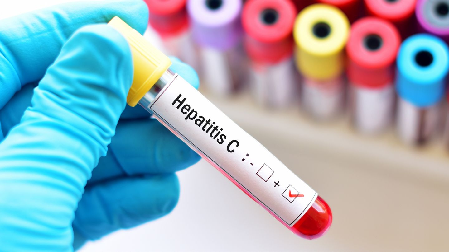 Hepatitis C: Eine Hand mit blauem Schutzhandschuh hält ein Blutteströhrchen mit einem Aufkleber mit der Aufschrift Hepatitis C.