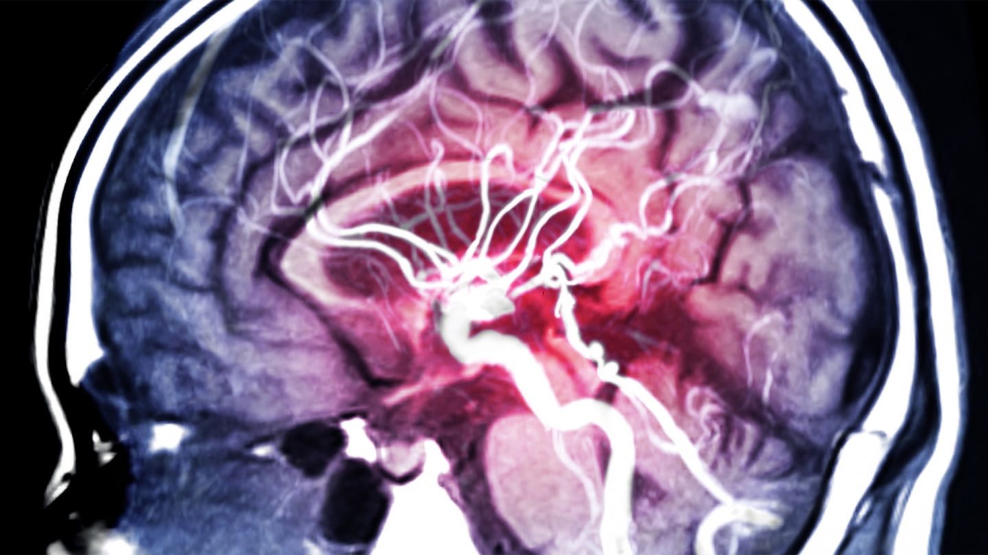Hirnaneurysma: Zu sehen ist die Aufnahme eines menschlichen Gehirns im Querschnitt. Deutlich zu sehen sind die Blutgefäße und die Hirnschlagader.