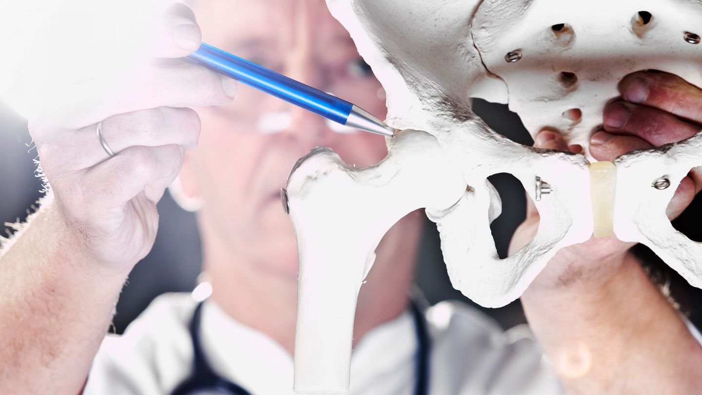 Hüftarthrose: Ein Arzt zeigt mit einem Stift auf den Knochen eines künstliches Gelenkes.