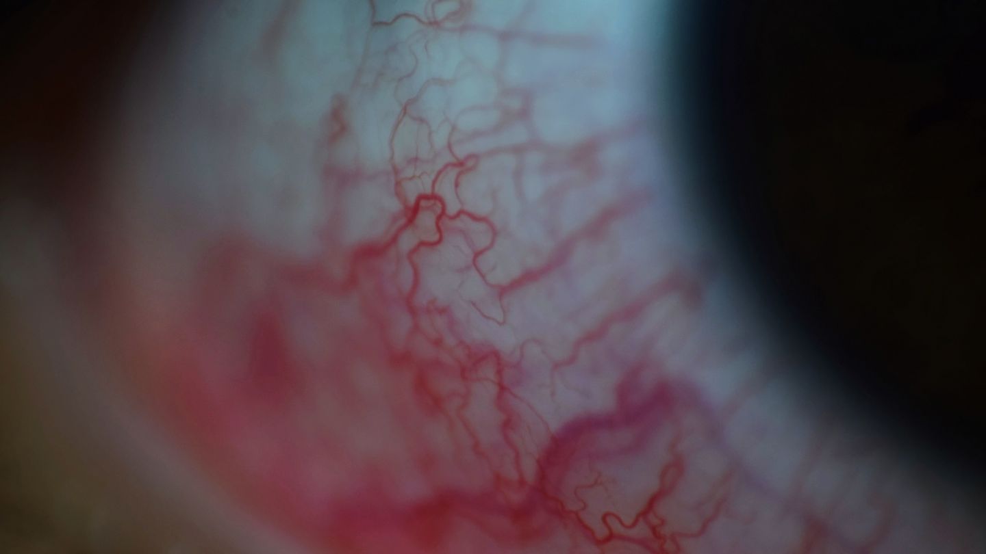 Kleine Fremdkörper im Auge: Nahaufnahme eines menschlichen Auges. Deutlich zu erkennen sind zahlreiche feine und rote Blutäderchen am weißfarbenen Augapfel.
