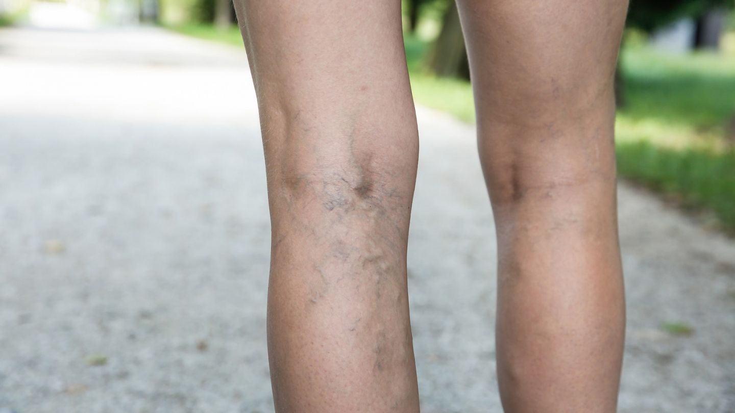 Krampfadern: Eine Frau zeigt ihre unbekleideten Beine. An ihnen verlaufen jeweils mehrere blaufarbene Krampfadern. Im Bereich der Kniekehlen sind die Krampfadern am sichtbarsten ausgeprägt.
