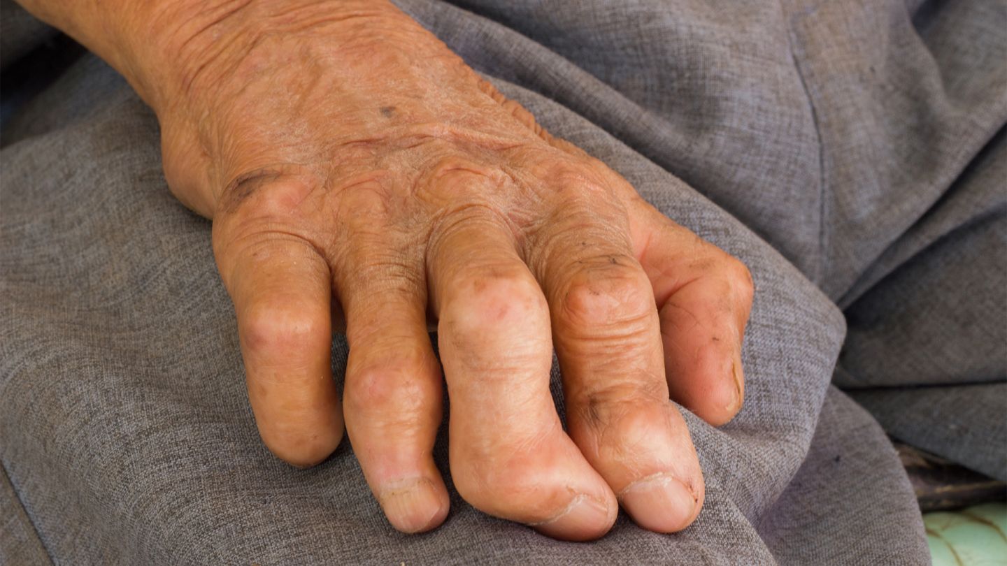 Hand showing signs of leprosy resting on a person’s thigh. The fingers of the hand are deformed.