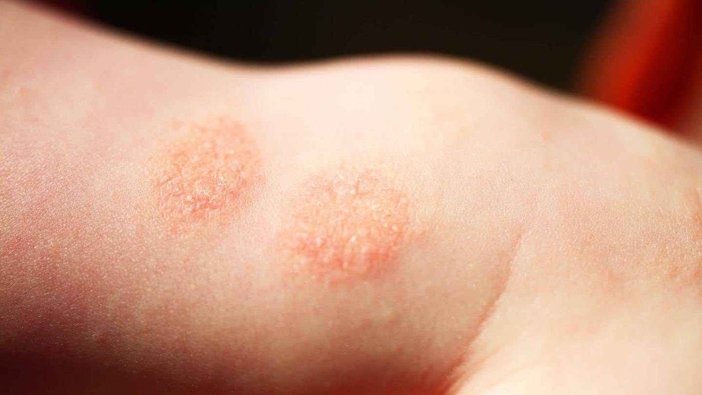 Part of a human body with reddish-brown disk-shaped skin rash.