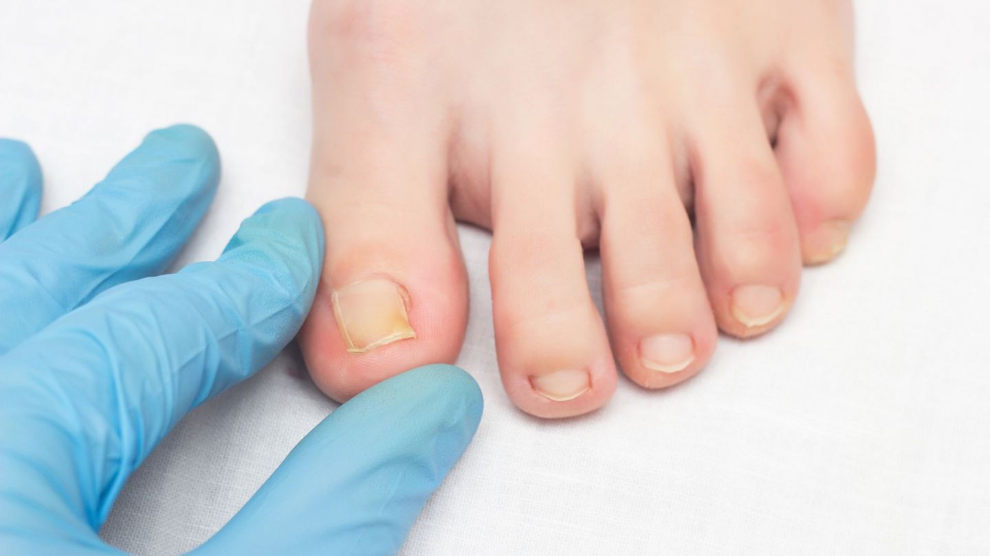 Ingrown nail: doctor wearing a surgical glove touching a young person’s big toe with two fingers. There is an ingrown nail on the toe. The skin around the toenail is slightly red.