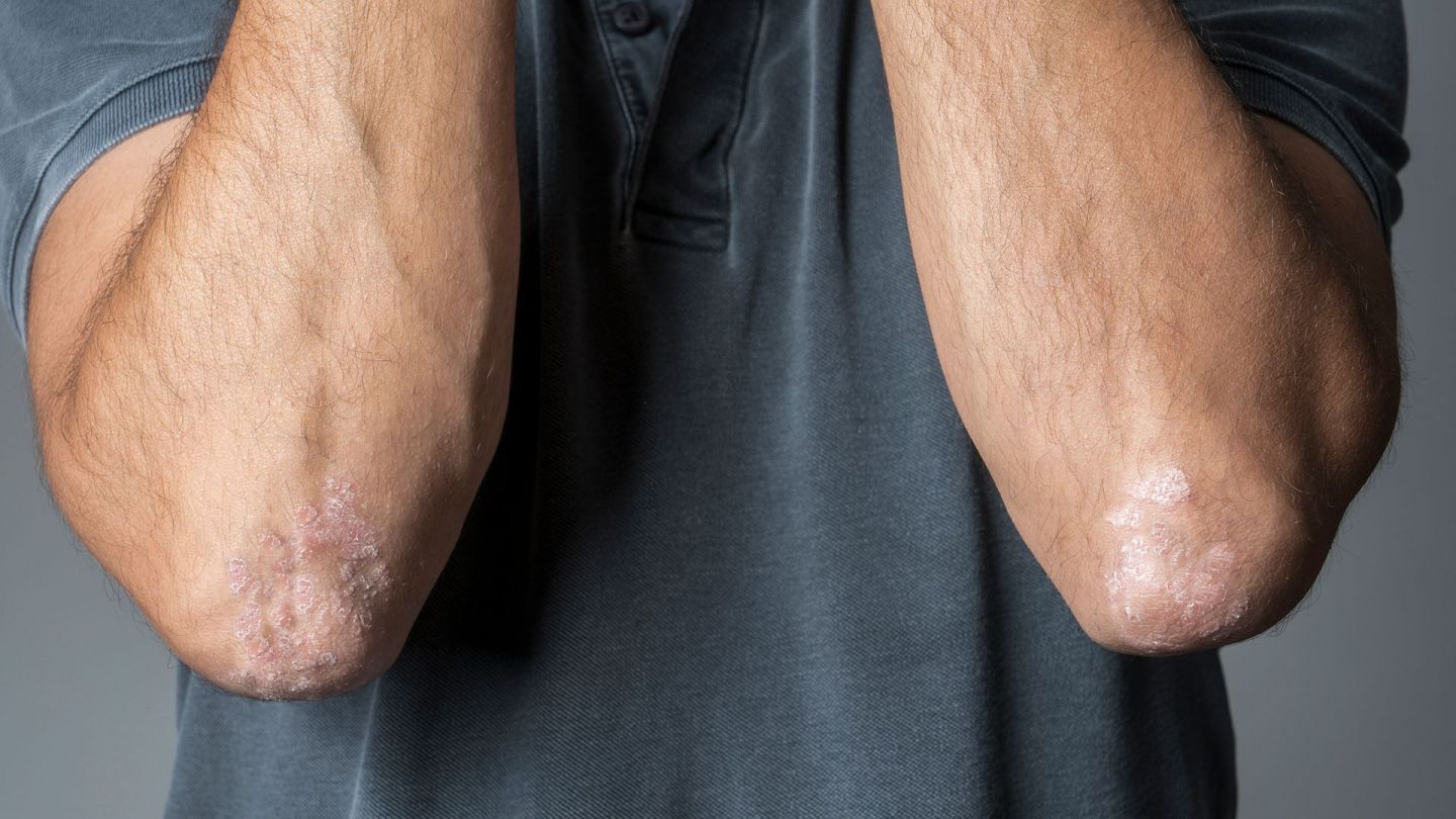 Sedef hastalığı: Bir adam, dirsekleri görünecek şekilde kollarını gövdesine doğru büker. Her iki dirsekte de sedef hastalığı var.