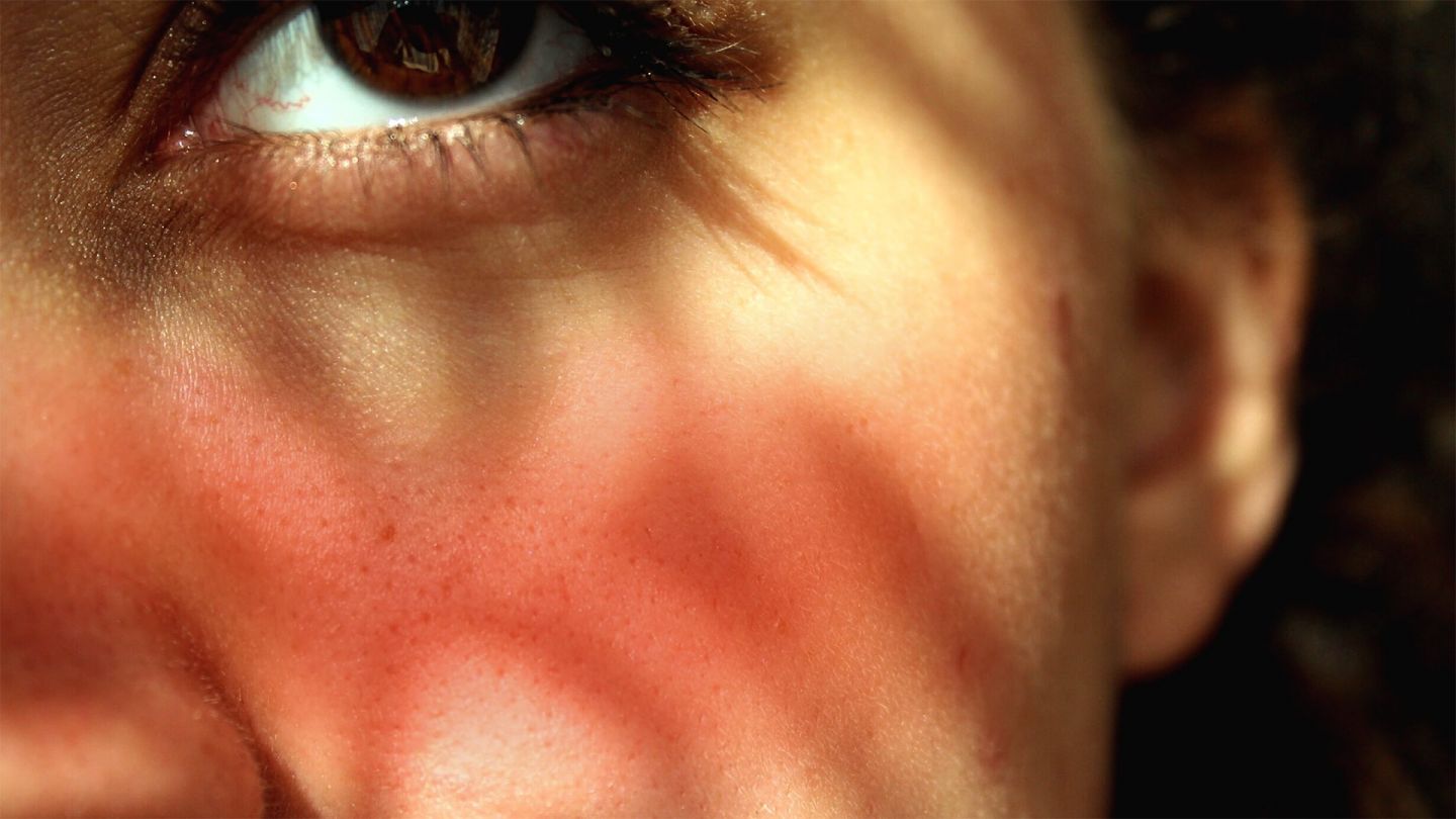 Rosacea: woman’s cheek slightly reddened. There are red veins visible in her eye.