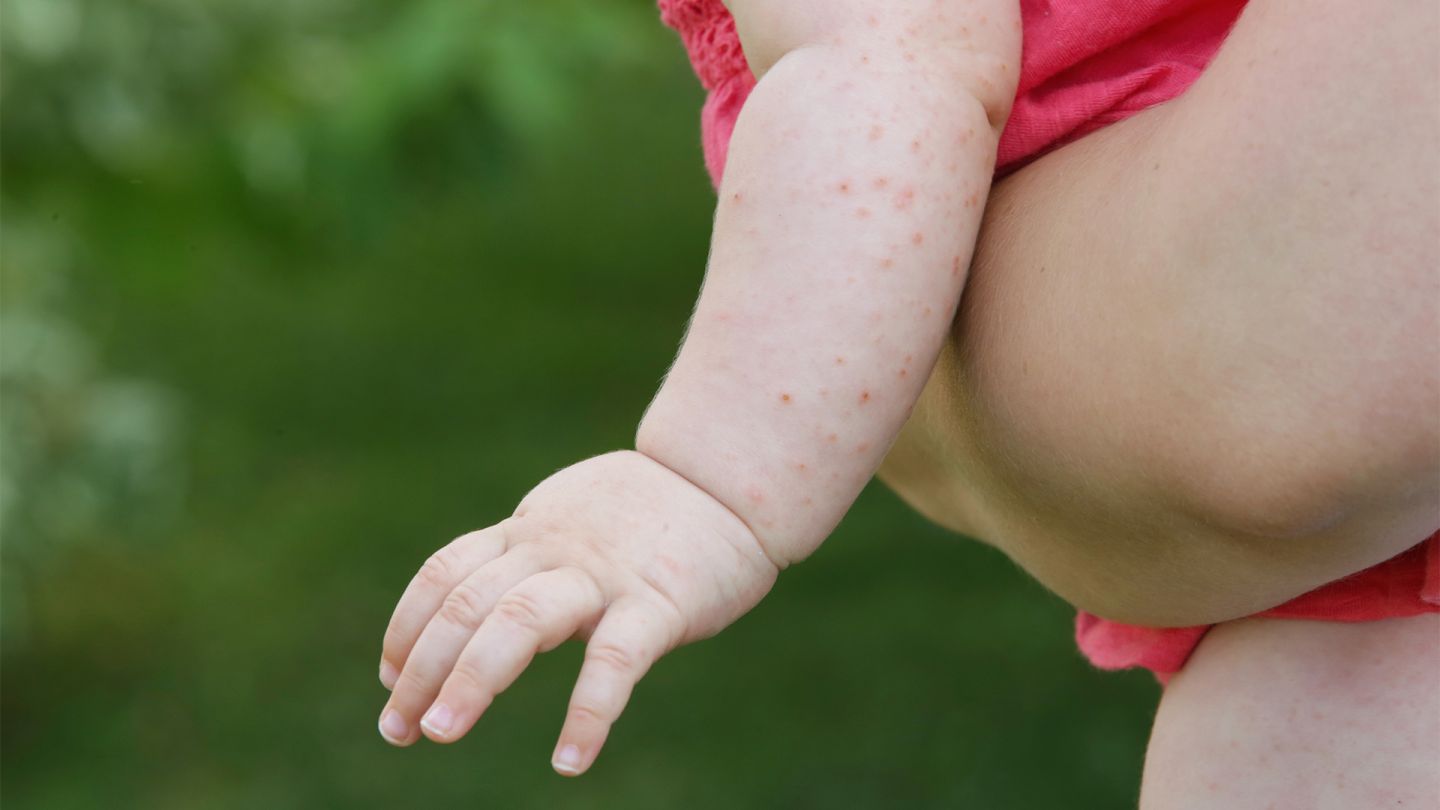 Scharlach: Der Arm eines Babys ist von einem roten Hautausschlag befallen.