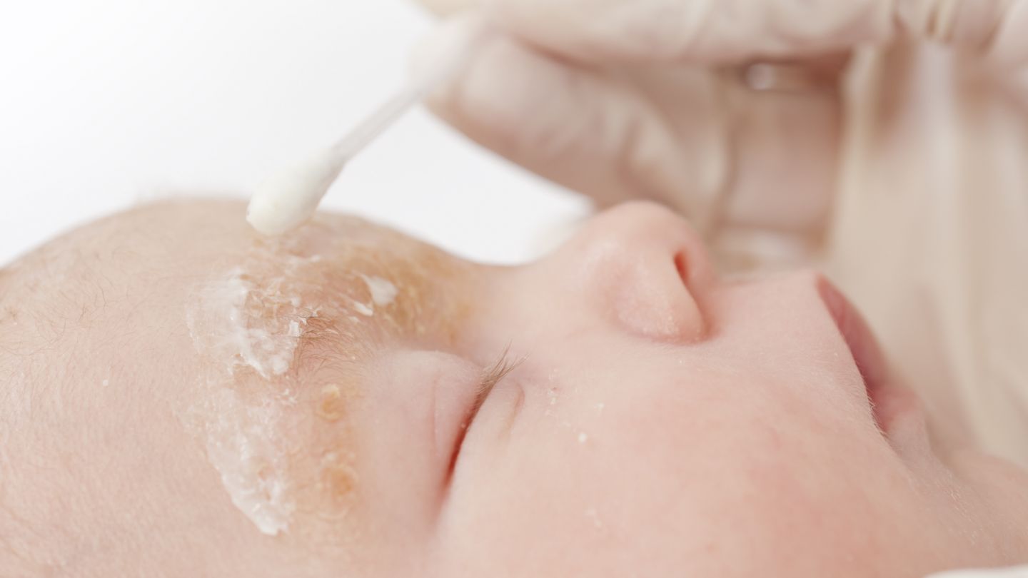 Seborrhoisches Ekzem: Ein Baby liegt mit geschlossenen Augen auf einem Kissen. Über den Augenbrauen ist die Haut gelblich verfärbt und geschuppt. Eine Person mit Medizinhandschuh trägt Salbe auf die entzündete Hautstellen auf.