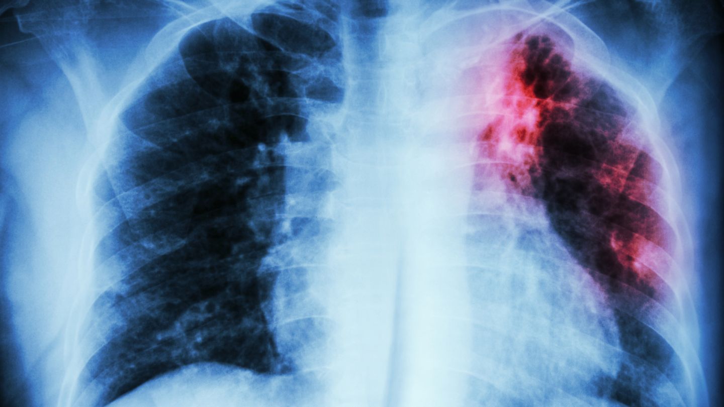 Tuberculosis: chest X-ray A reddish-black stain in the left lung indicates a tuberculosis infection.