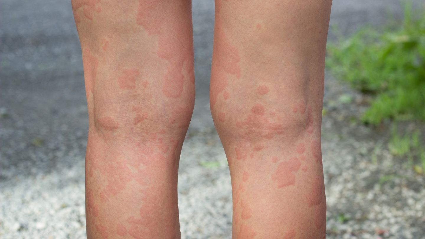 Urticaria: a person’s naked legs, covered all over with a rash. The rash is reddish and looks swollen.