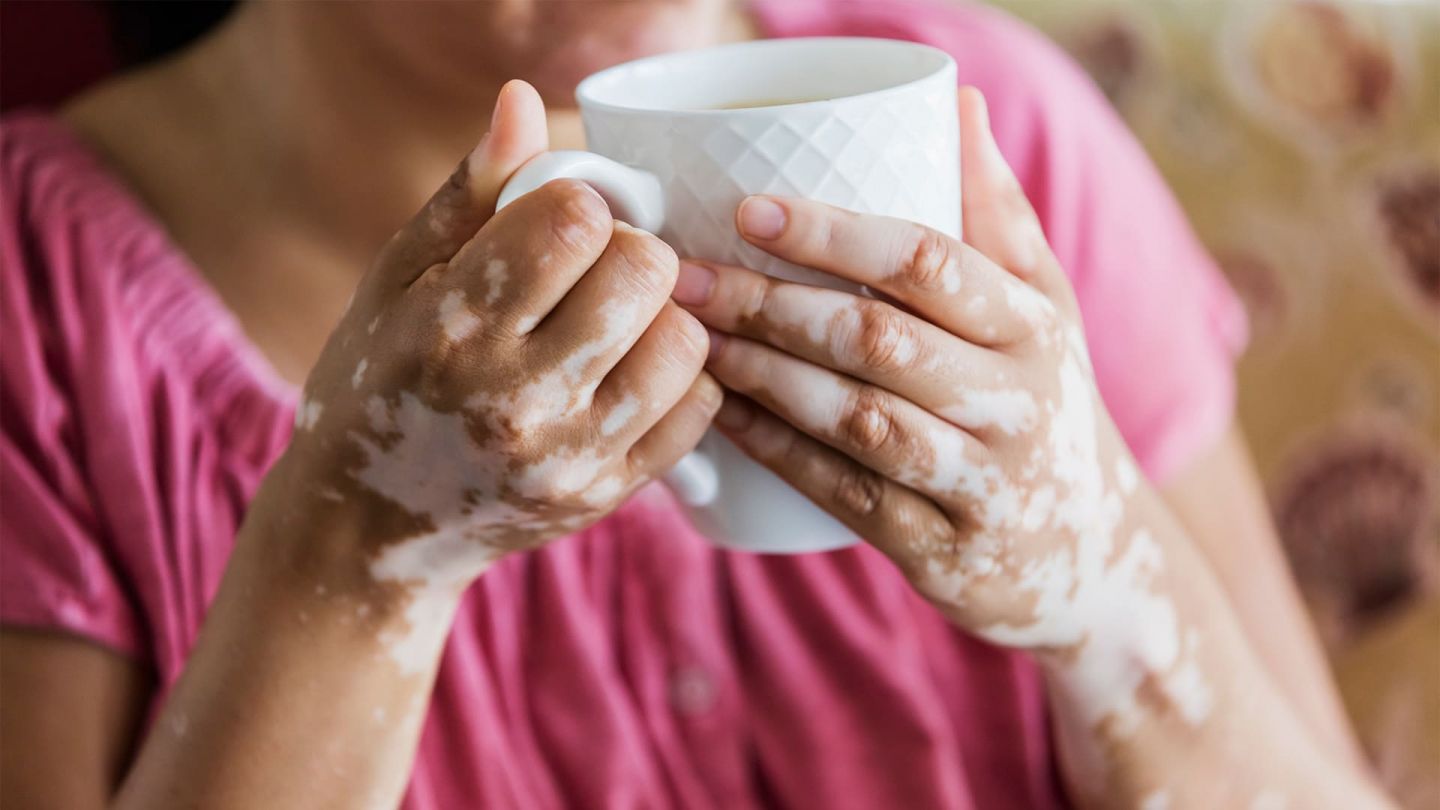 Vitiligo: woman holding a cup of tea in both hands. The pigmentation on her skin is normal apart from white patches on her hands and forearms.