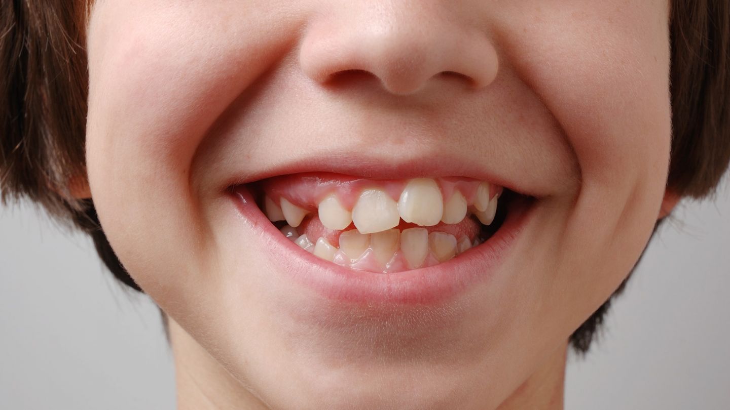 Yanlış hizalanmış dişler ve çeneler: Bir çocuk dişlerini göstererek gülümsüyor. Dişlerinin çoğu çarpık ve yanlış hizalanmış.