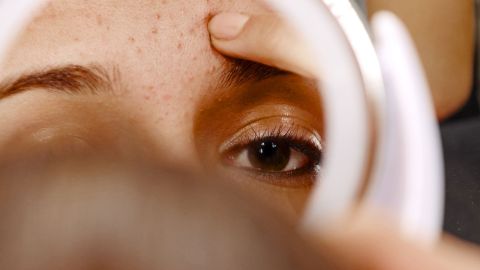 Acne: young woman looking at her face in the mirror.