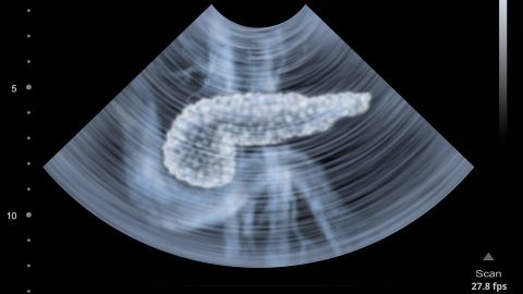 Pancreatic cancer: ultrasound scan of a human pancreas.