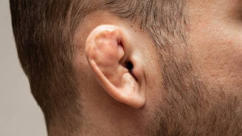 Aşırı büyümüş kıkırdaklı kulak hematomunun fotoğrafı