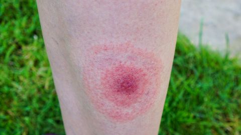 Боррелиоз: округлое покраснение на коже, так называемая мигрирующая эритема, образовавшаяся на ноге после укуса клеща.