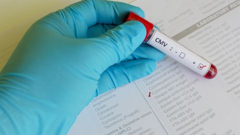 Cytomegalovirus infection: hand in a blue protective glove holding a test tube over a form with a tick (check) against Cytomegalovirus IgM. There is a sticker on the tube with the result “CMV positive”.