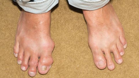 Gout: two bare feet of a man standing on the ground.