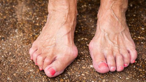 Hallux valgus: shot of a woman’s two feet standing on the ground. The bigger toes on one foot are splayed and deformed.