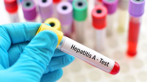Hepatitis A: hand in blue protective glove holding a blood test tube with a sticker labeled hepatitis A.