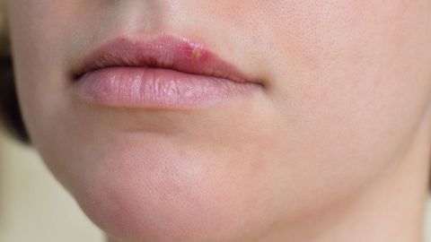 Herpes labialis: Genç bir kadının üst dudağında uçuk kabarcıkları var.