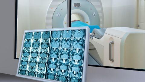 Hirntumoren: Auf einem Monitor sind mehrere MRT Scans eines Gehirns zu sehen. Im Hintergrund liegt ein Mann in einer MRT-Röhre.