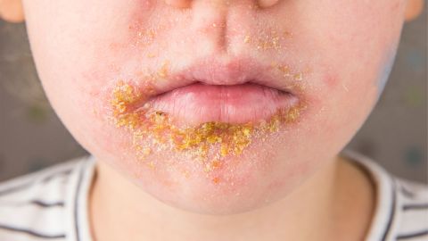 Impetigo contagiosa: impetigo spots on a boy’s mouth