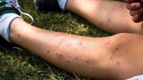 Укусы насекомых. Ноги молодого человека, сидящего на лугу, на которых в нескольких местах видны укусы, а также раны и царапины.