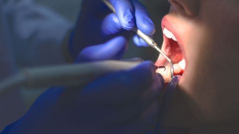 Caries: woman at the dentist’s opening her mouth. A doctor wearing surgical gloves and holding instruments is treating the teeth.