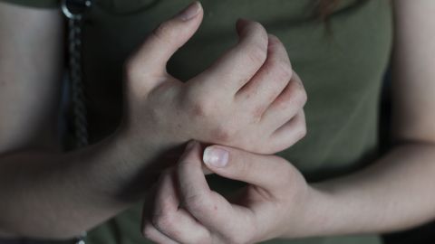 Krätze: Die Hände einer Frau weisen einen rötlichen Ausschlag auf. Mit der einen Hand kratzt die Frau sich ihre andere Hand.
