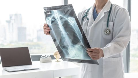Lung cancer: doctor holding an X-ray of a lung in both hands.