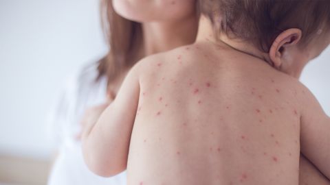 Rubella: mother with infant on her arm nuzzling the curve of her neck. The infant has a red spotty rash all down its back.