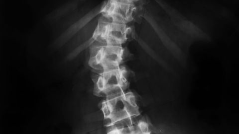 Scoliosis: black, gray and white X-ray of a spinal column
