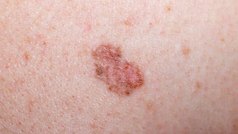 سرطان الجلد الأبيض: يظهر جزء من الجلد مصاب بسرطان الجلد الأبيض.
