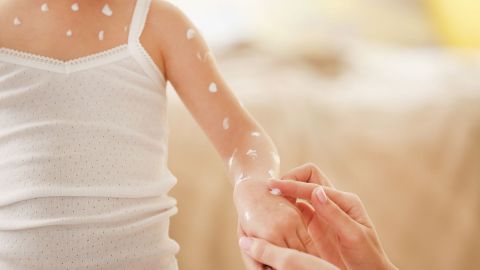 Chickenpox: ointment applied to several sites on a young girl’s breastbone and arm. An adult is applying cream to other sites on the girl’s wrist. There are red spots on the skin under the cream.