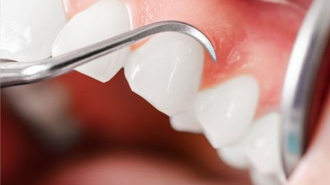 Der geöffnete Mund eines gesundes Gebisses mit strahlend weißen Zähnen. Im Vordergrund eine Zahnsonde aus Stahl.