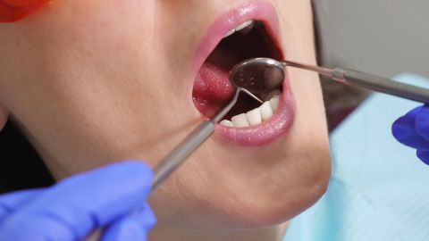 Zahnfleischentzündung: Eine Frau sitzt auf dem Behandlungstuhl eines Zahnarztes und öffnet ihren Mund. Der Arzt hält einen Zahnspiegel in einer Hand, in der anderen Hand einen Zahnsteinentferner. Er führt das Besteck zum Mund und untersucht das Gebiss.