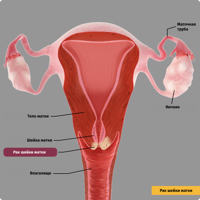Рак шейки матки. Злокачественные клетки прорастают в окружающие ткани (инвазивная карцинома).