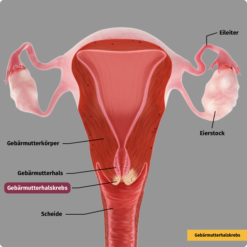 Geb&auml;rmutterhalskrebs. B&ouml;sartige Zellen wachsen in das umliegende Gewebe ein (invasives Karzinom).
