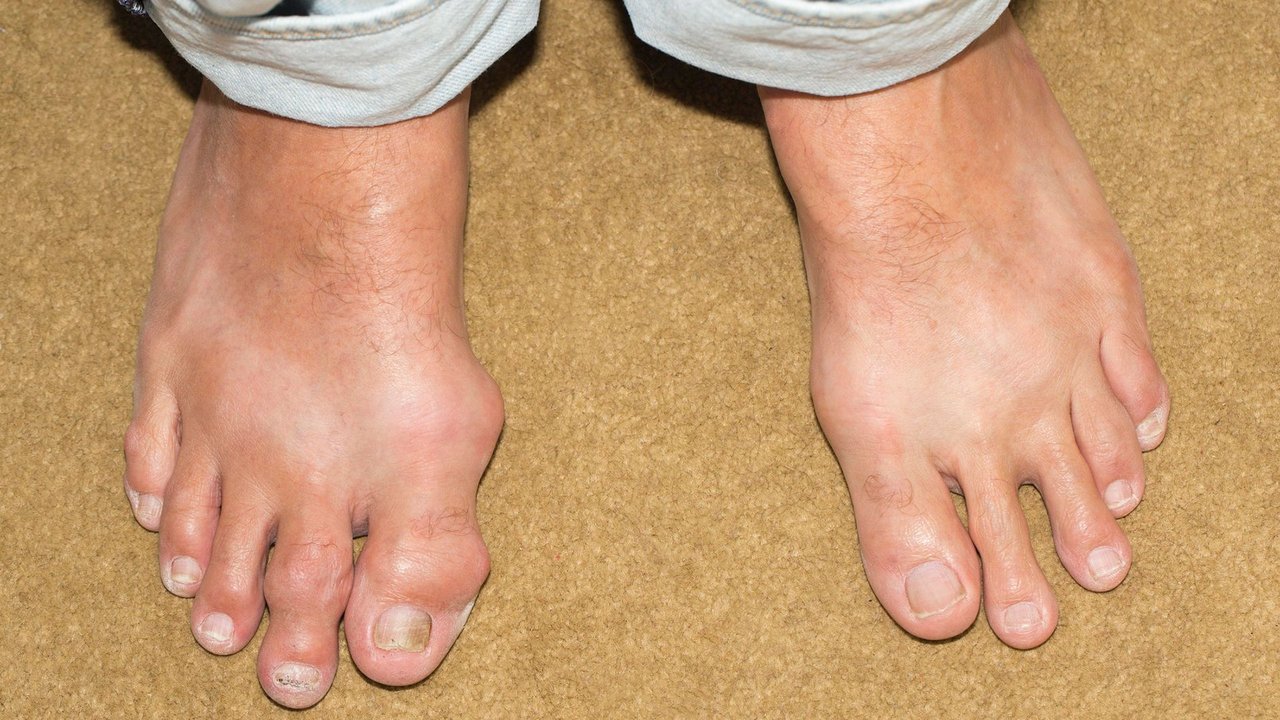 Gicht: Ursachen, Verlauf, Behandlung | gesund.bund.de