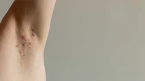 Rötliche Veränderungen unter der Achsel eines Patienten mit Akne inversa. 